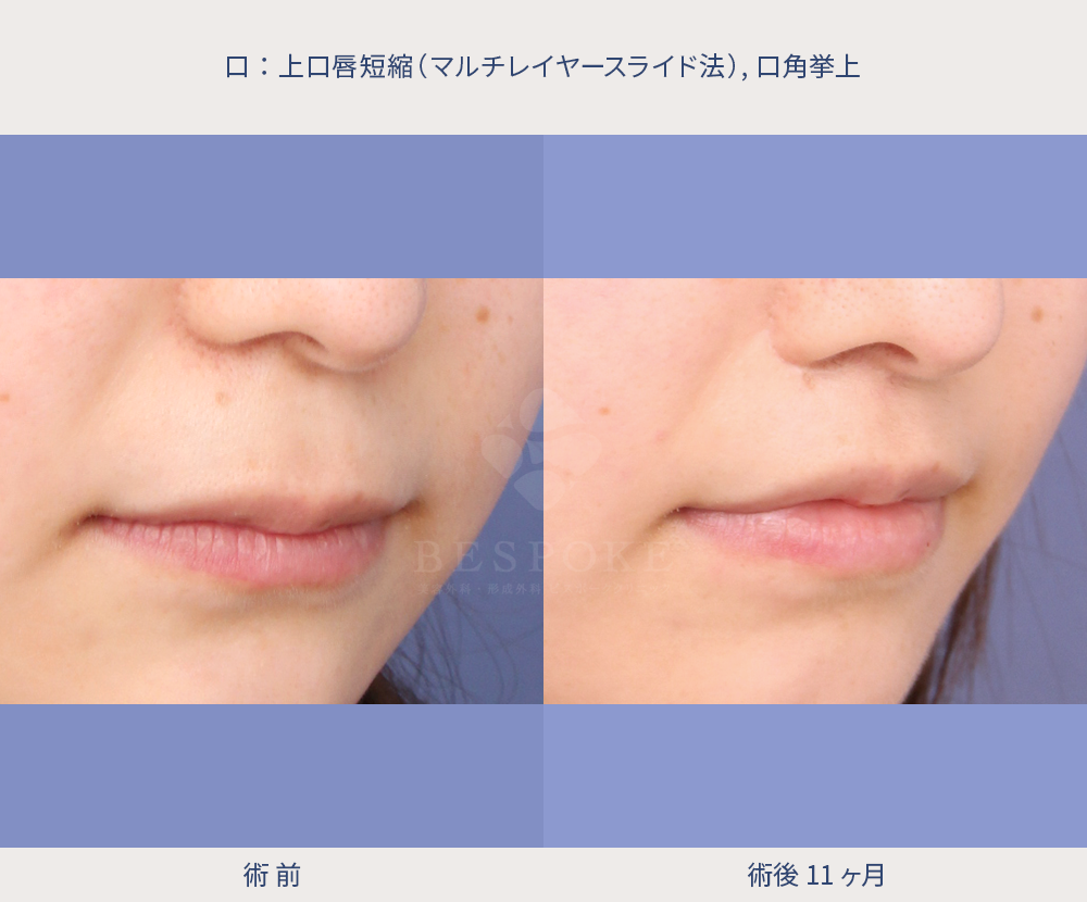 上口唇短縮の患者様 上口唇短縮の患者様の症例写真(右斜め/拡大)