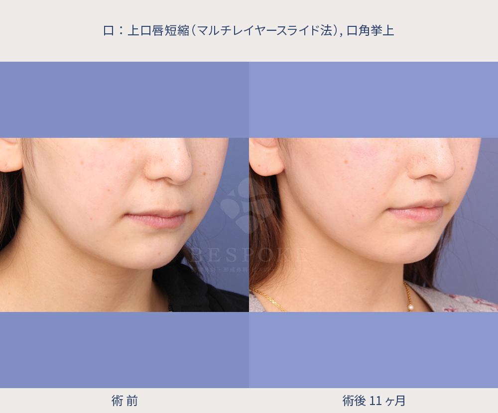 上口唇短縮の患者様 上口唇短縮の患者様の症例写真(右斜め)
