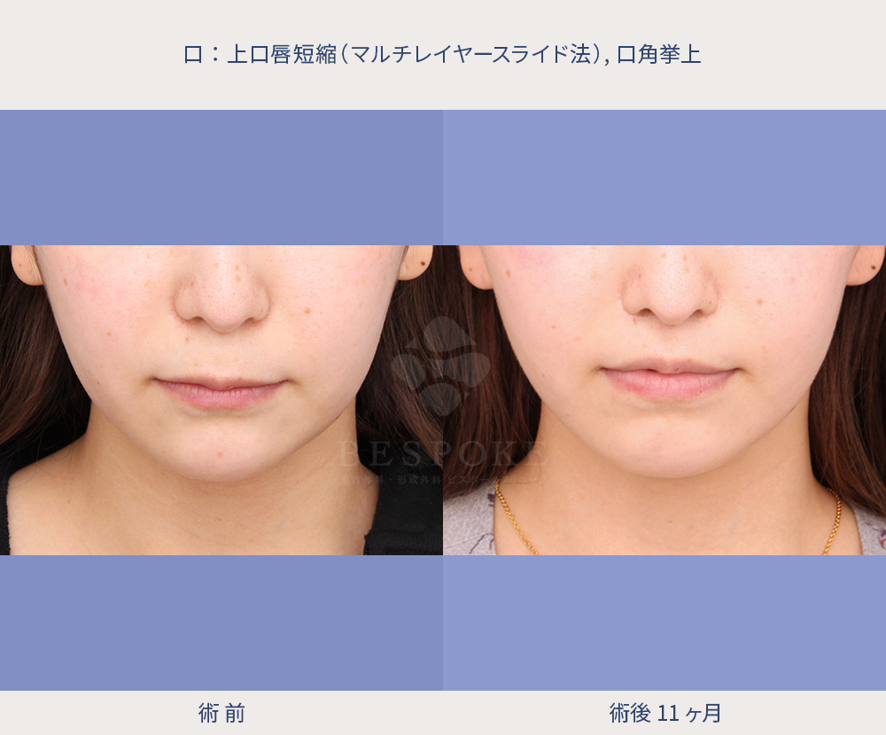 上口唇短縮の患者様 上口唇短縮の患者様の症例写真(正面)