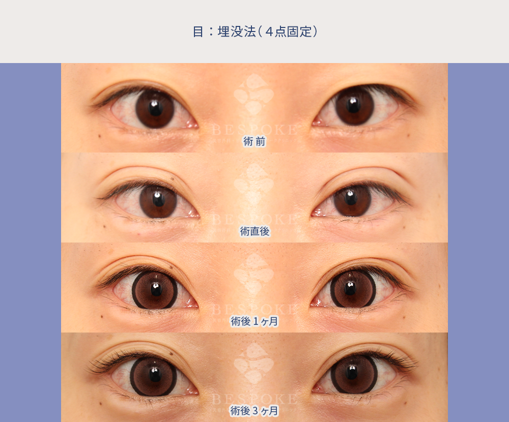 埋没法の術前術後の経過の写真（術前~術後3ヶ月まで）：正面・開眼