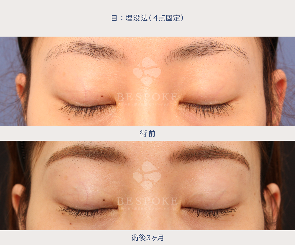 埋没法の術前術後（3ヶ月後）写真：正面・閉眼