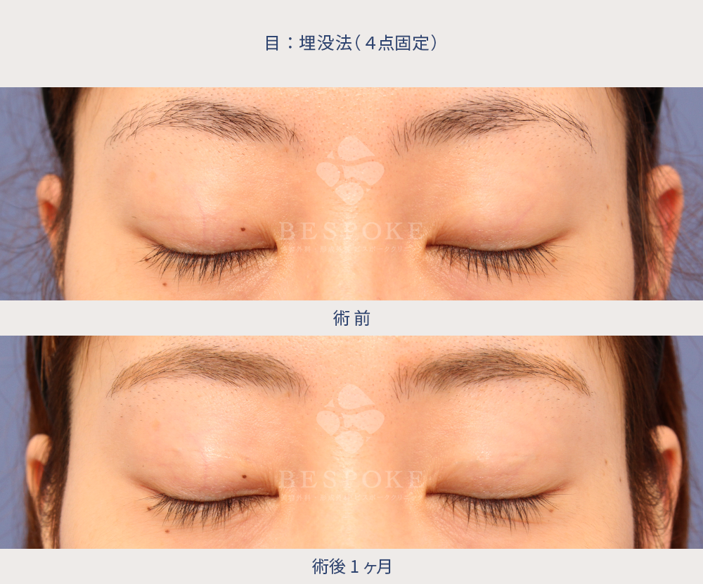 埋没法の術前術後（1ヶ月後）写真：正面・閉眼