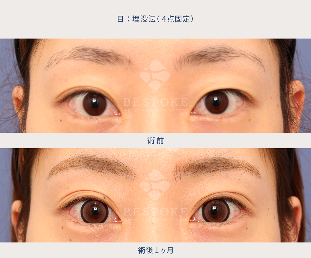 埋没法の術前術後（1ヶ月後）写真：正面・開眼