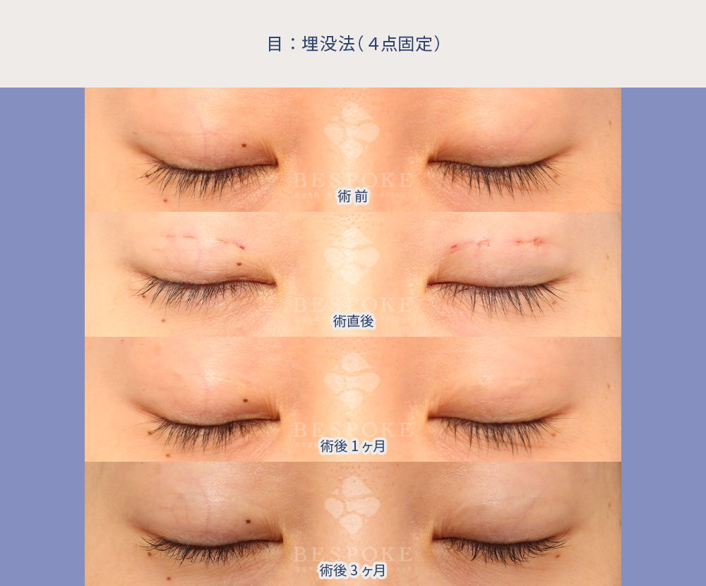 埋没法の術前術後の経過の写真（術前~術後3ヶ月まで）：正面・閉眼