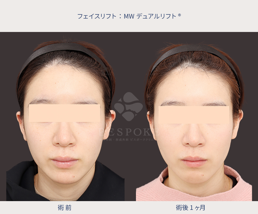 MWデュアルリフト症例術前術後写真（正面）