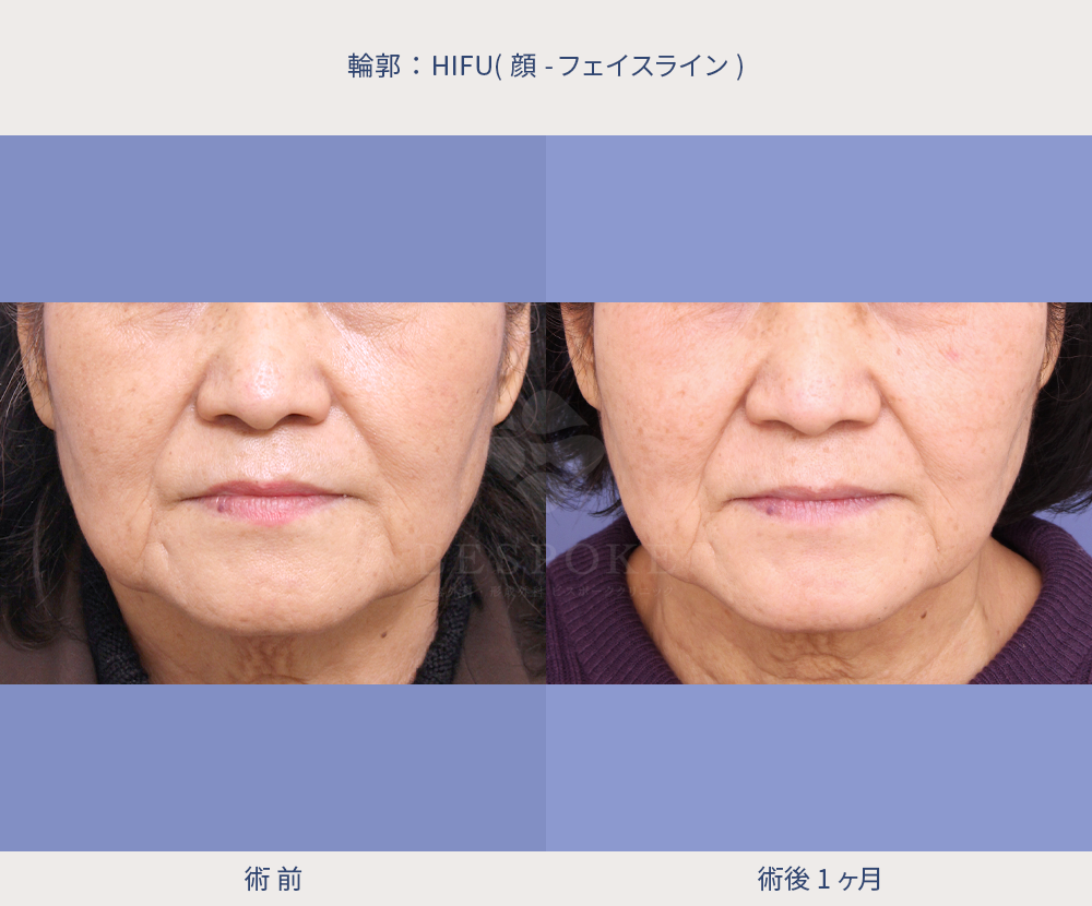 HIFU(顔～フェイスライン)正面の症例写真