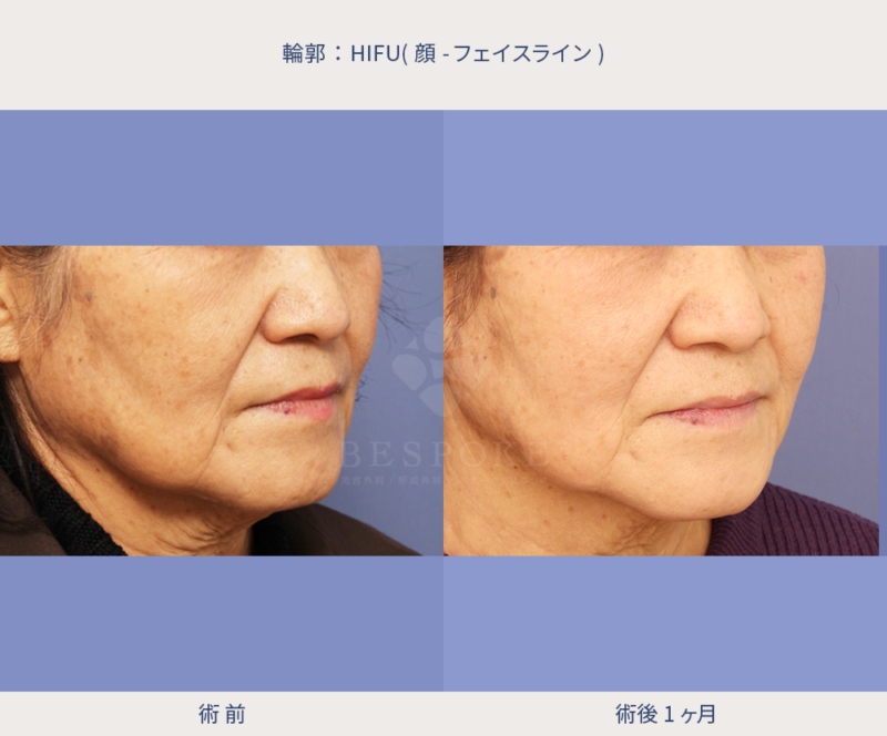 HIFU(顔～フェイスライン)右斜の症例写真