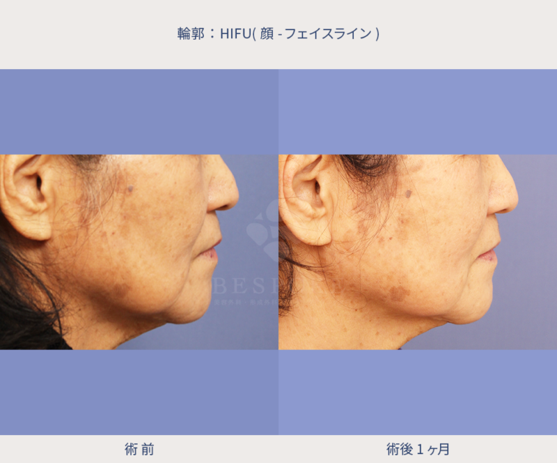 HIFU(顔～フェイスライン)右側面の症例写真