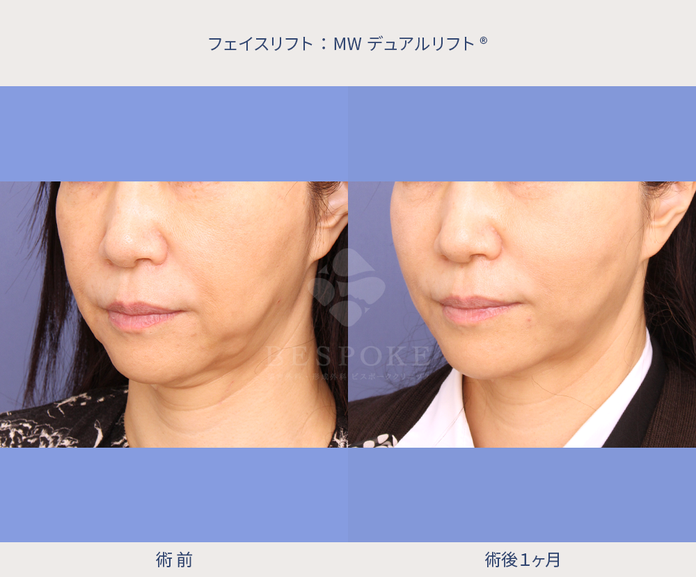 MWデュアルリフト症例術前術後1ヶ月写真（左斜）