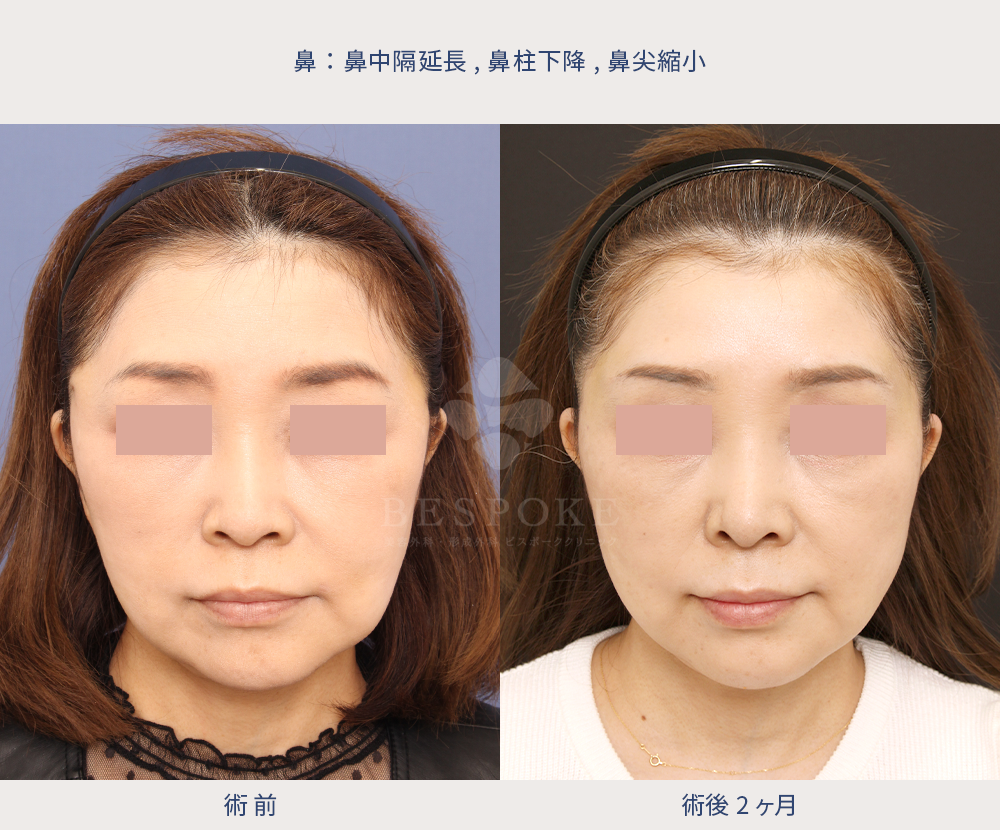 鼻の施術の術前術後写真（正面）