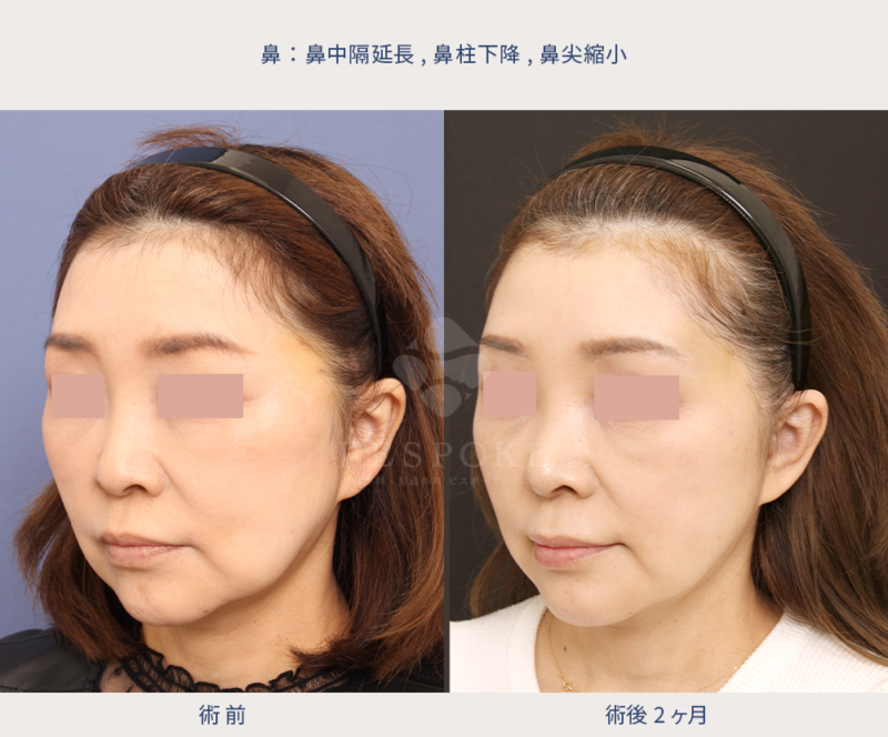 鼻の施術の術前術後写真（左斜）