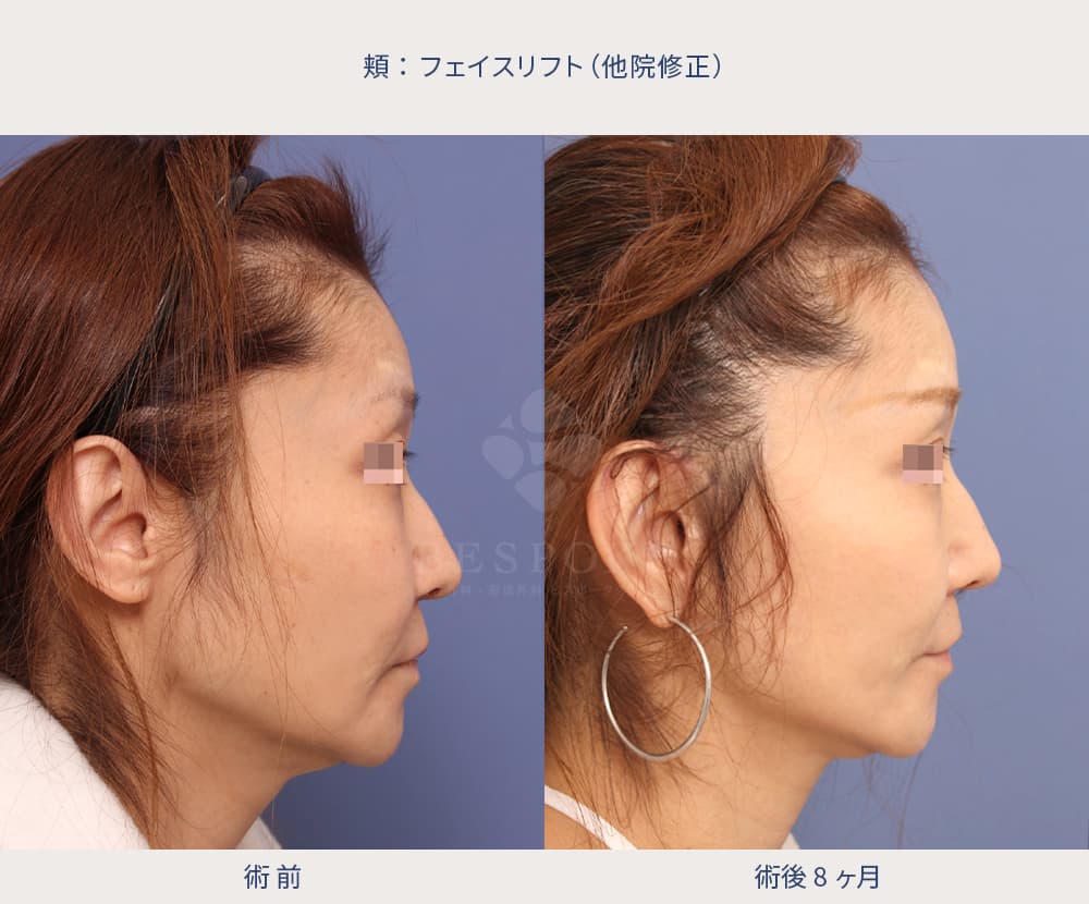 他院修正のフェイスリフト症例写真（右側面）