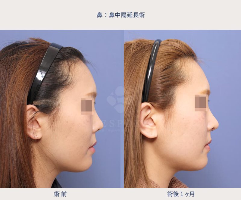鼻中隔延長症例写真（右側面）