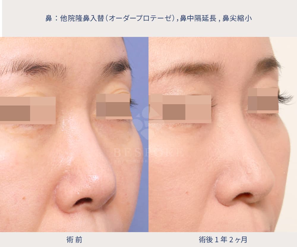 隆鼻入替・鼻尖縮小・鼻中隔延長症例写真（正面）