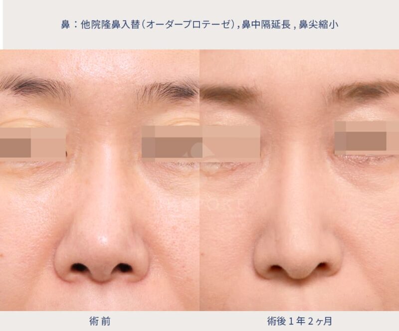隆鼻入替・鼻尖縮小・鼻中隔延長症例写真（正面）
