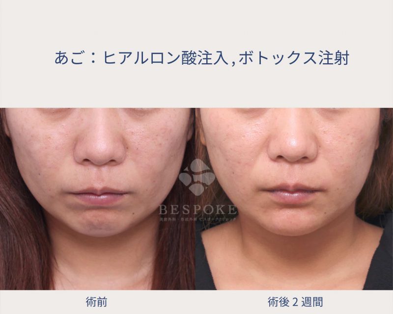 ヒアルロン酸+ボトックスの顎への注入症例写真（正面）