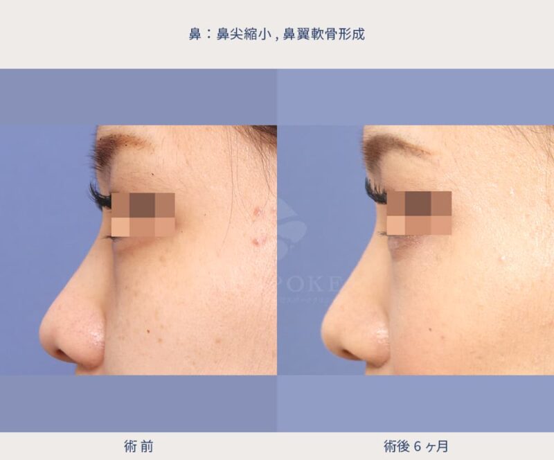 鼻尖縮小(室式)・鼻翼軟骨形成_症例写真（左側面）