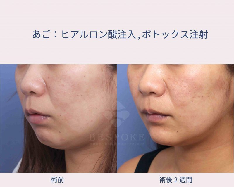 ヒアルロン酸+ボトックスの顎への注入症例写真（左斜め）