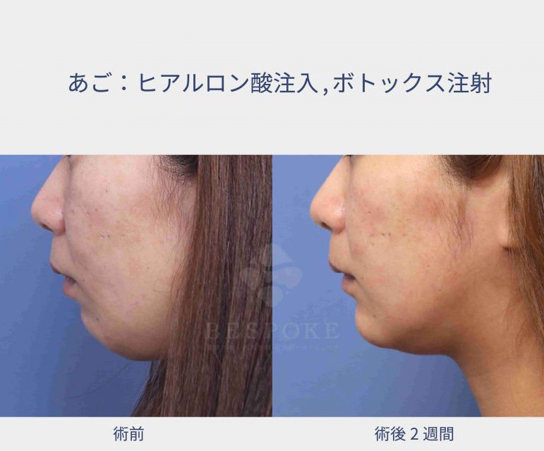 ヒアルロン酸+ボトックスの顎への注入症例写真（左側面）