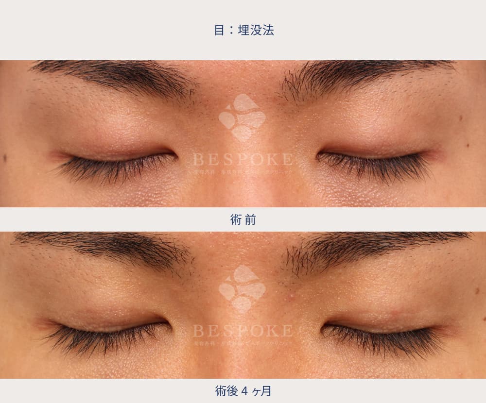 埋没法の症例写真