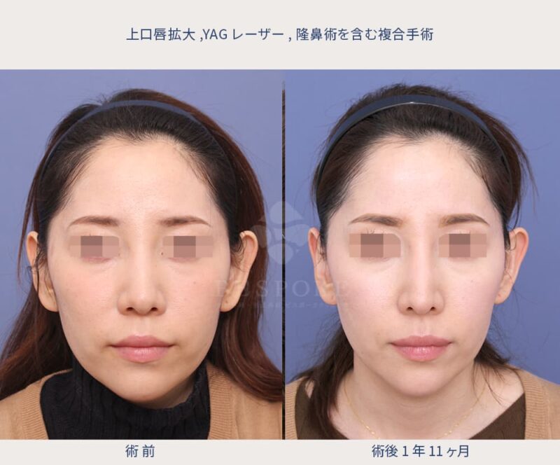 室医師による複合的な美容手術の症例写真-2