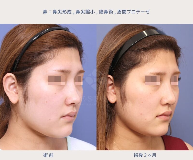 室医師による鼻の美容整形の症例写真-2