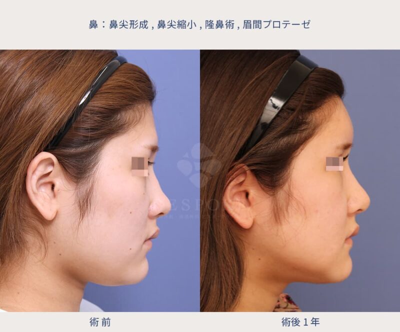 室医師による鼻の美容整形の症例写真-4