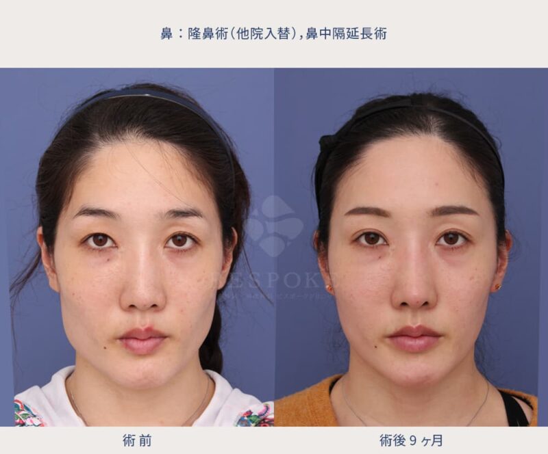 鼻の整形の術前術後の症例写真
