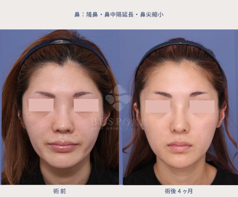 室医師による鼻の美容整形の症例写真