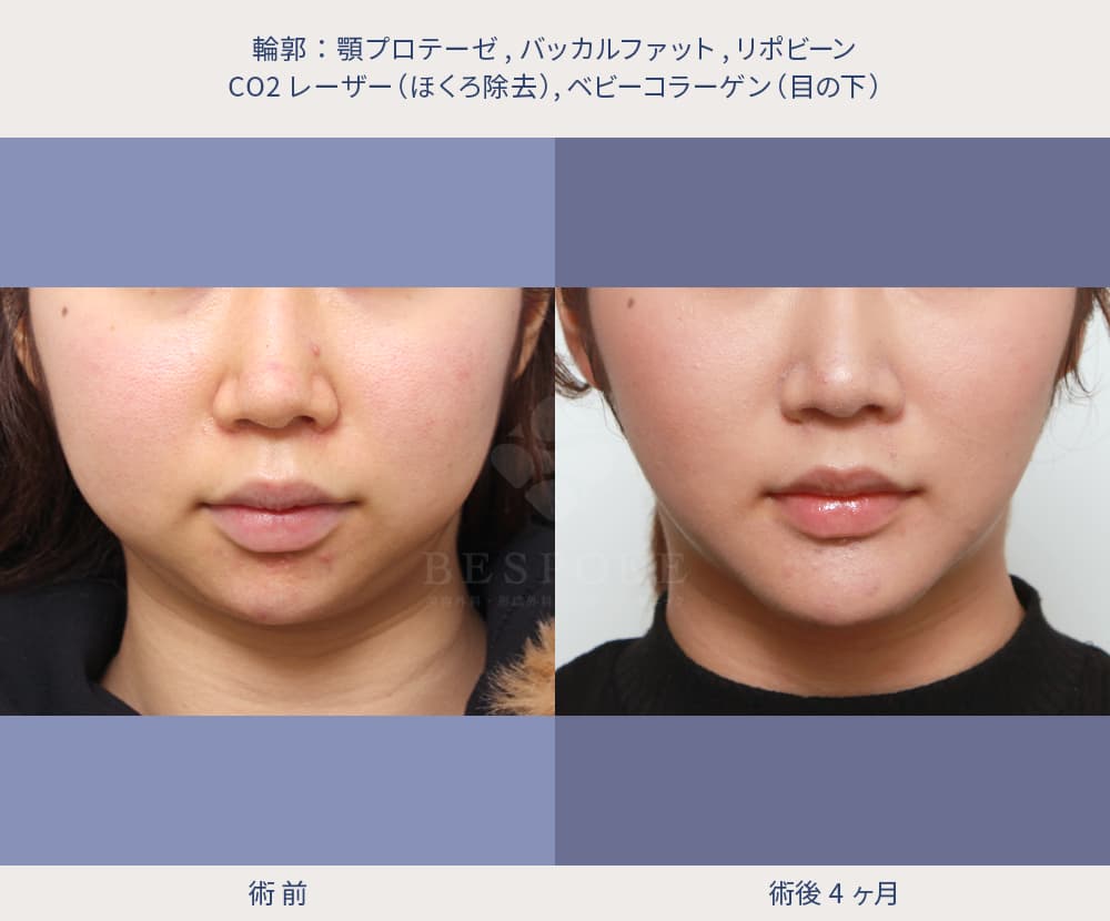 顎の美容施術の症例写真