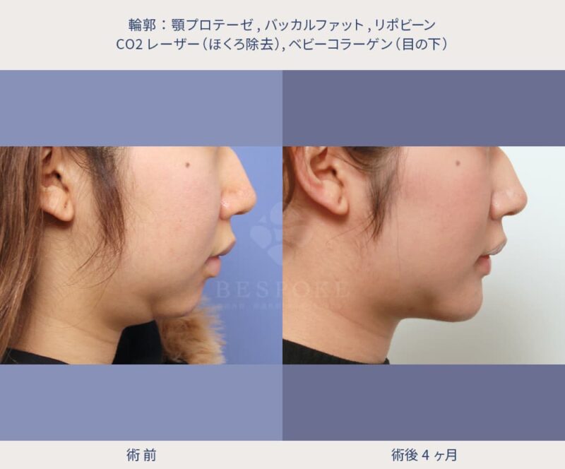 顎の美容施術の症例写真（右側面）