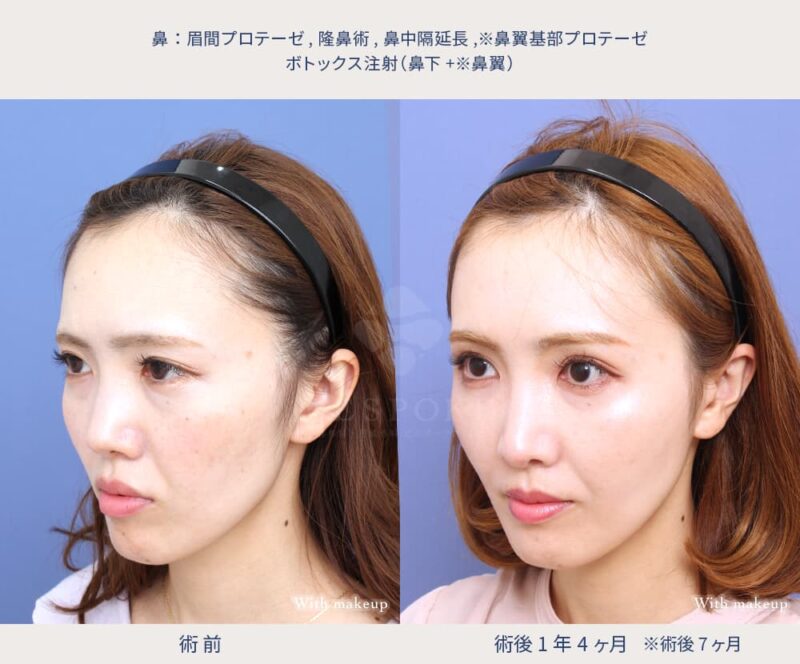 鼻の複合手術の症例写真（左斜め）