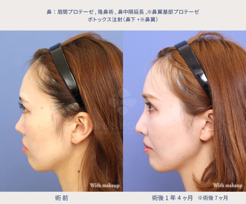 鼻の複合手術の症例写真（左側面）