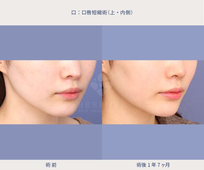 室医師による口の美容手術の症例写真（右側面）