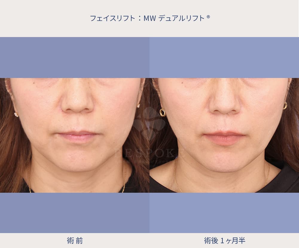 MWデュアルリフトの症例写真（拡大）