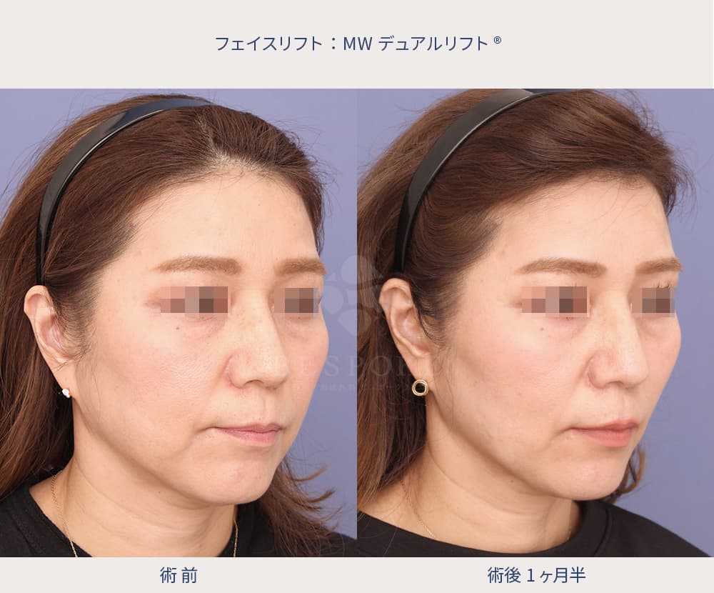 MWデュアルリフト（糸リフト）の症例