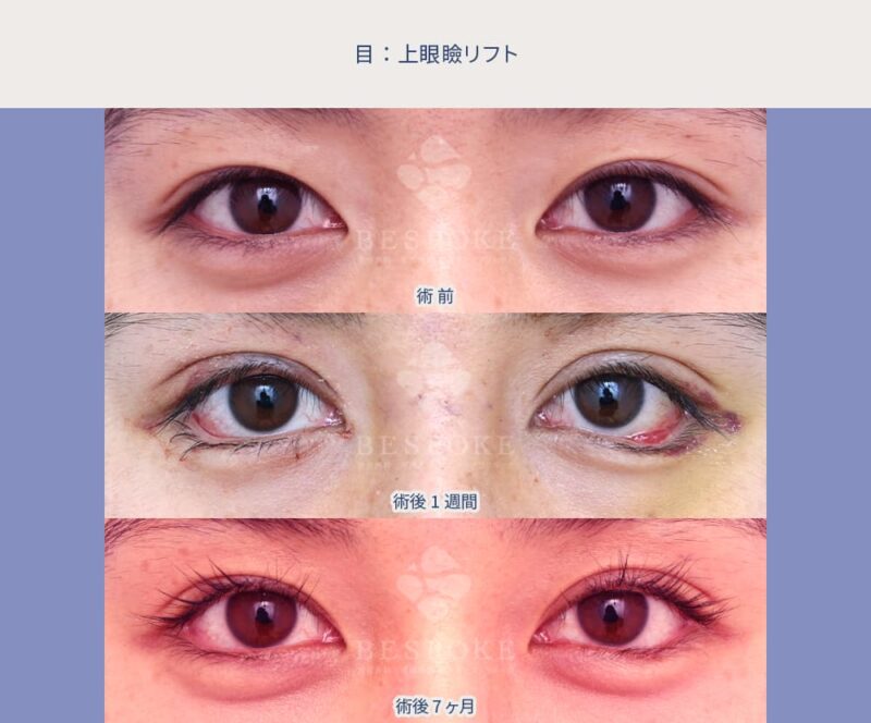 室医師による目の美容整形の症例写真