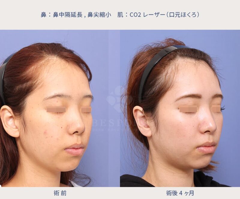 室医師による鼻の美容整形の症例写真