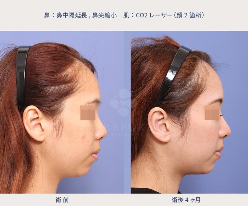 室医師による鼻の美容整形の症例写真-3
