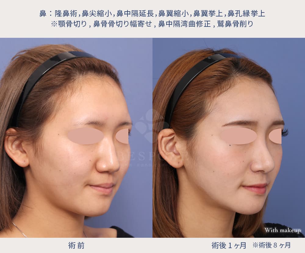 鼻整形によって顔の曲がり・左右差が改善した症例写真