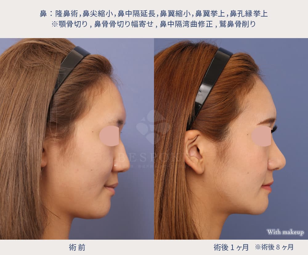 鼻整形によって顔の曲がり・左右差が改善した症例写真