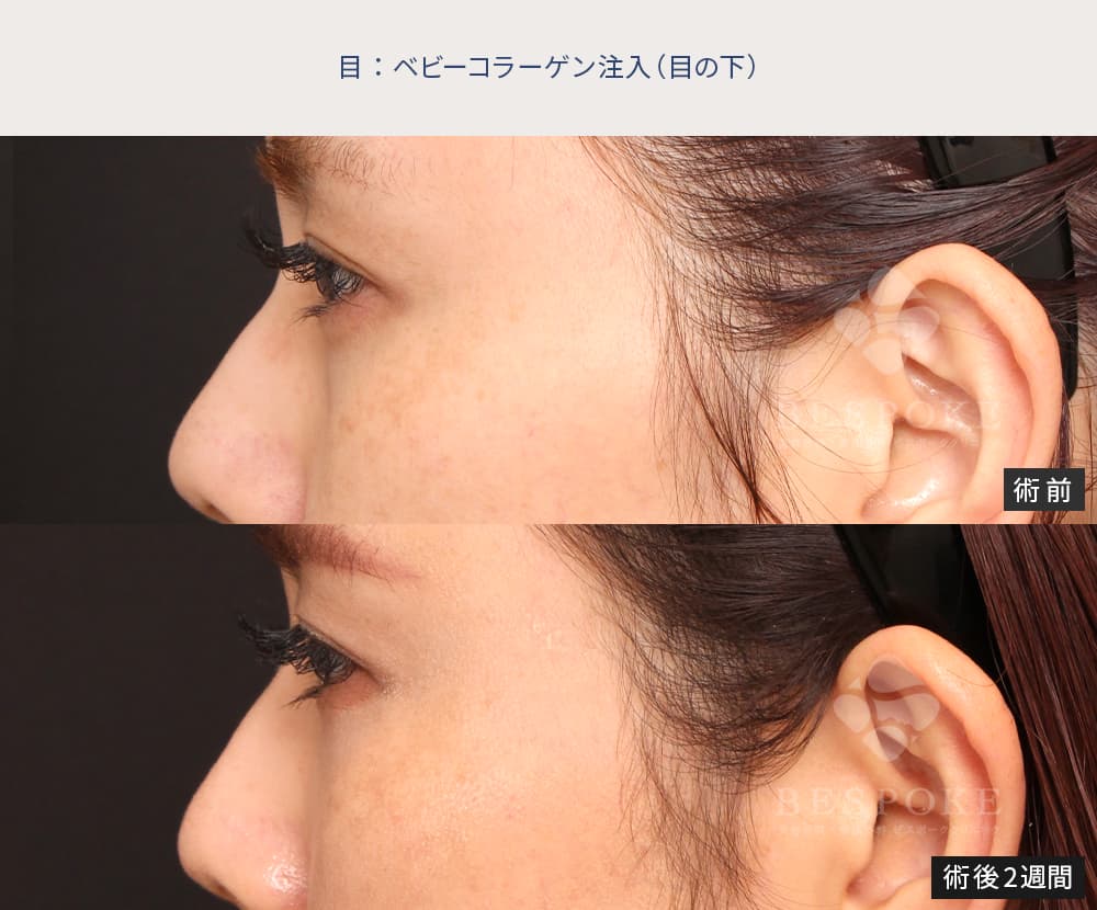 ベビーコラーゲン注入による目の下のクマ、たるみ改善の症例
