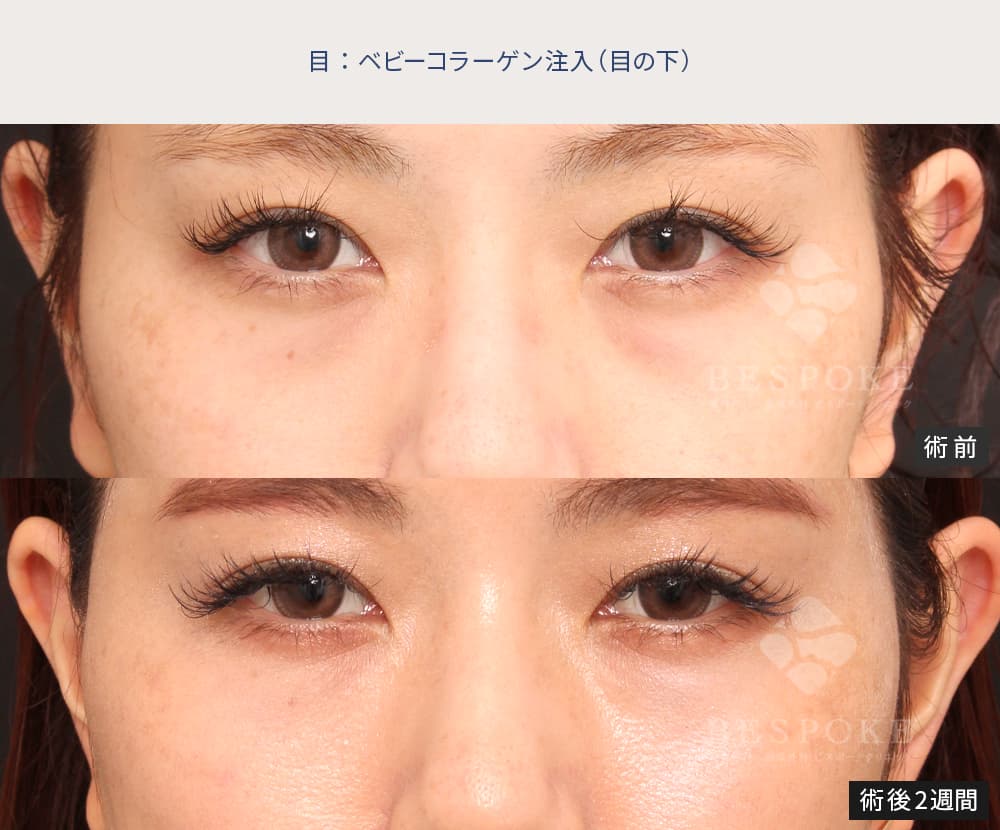 ベビーコラーゲン注入による目の下のクマ、たるみ改善の症例