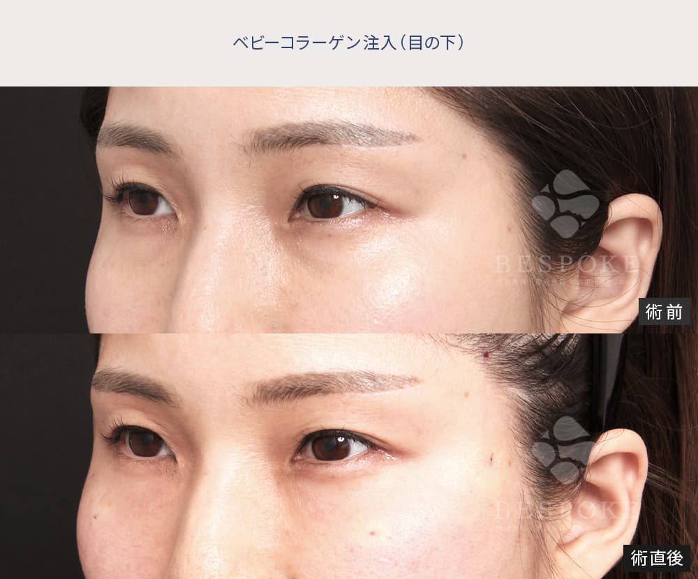 五反田医師によるクマ取り治療の症例-2