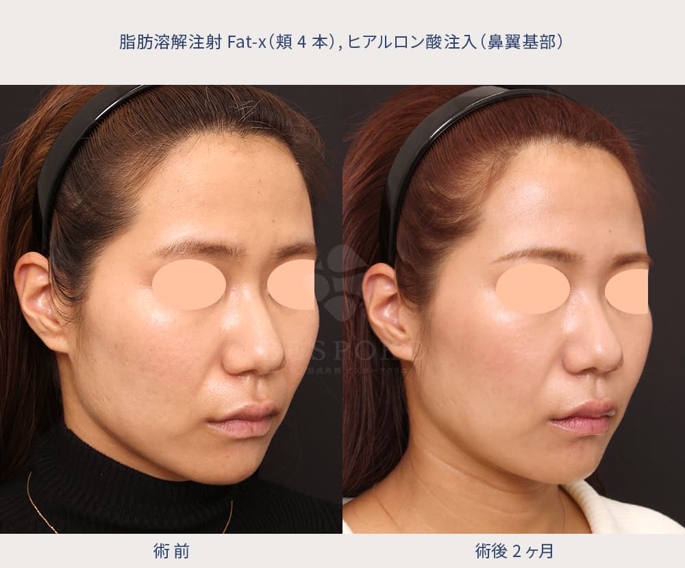 ほうれい線を薄くする施術の症例写真-2