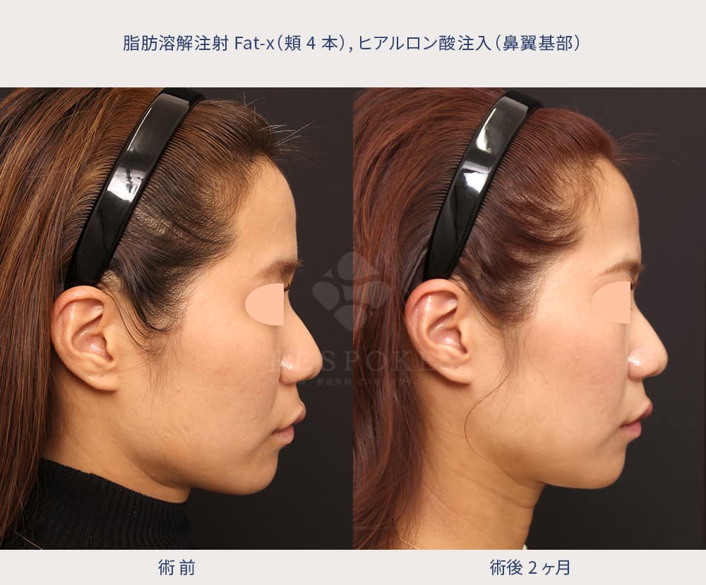 ほうれい線を薄くする施術の症例写真-3