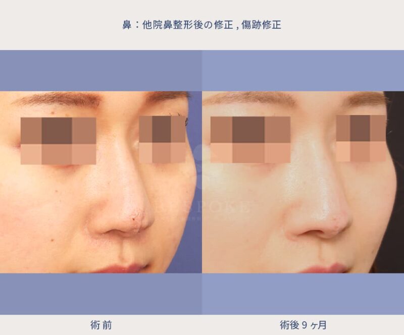 室医師による鼻の傷跡修正の症例写真-2