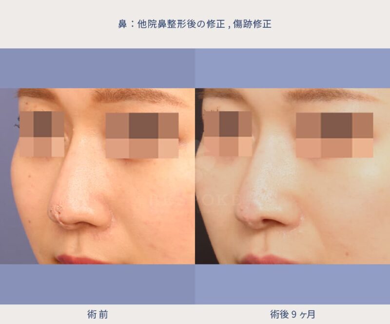 室医師による鼻の傷跡修正の症例写真-3