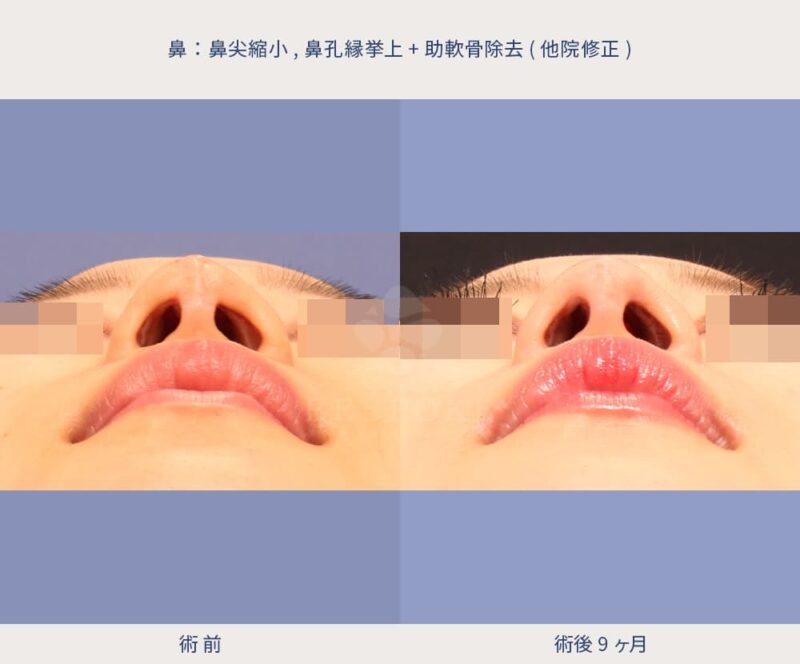 室医師による鼻の傷跡修正の症例写真-4