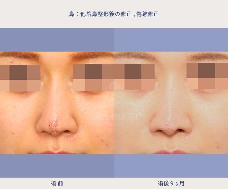 室医師による鼻の傷跡修正の症例写真